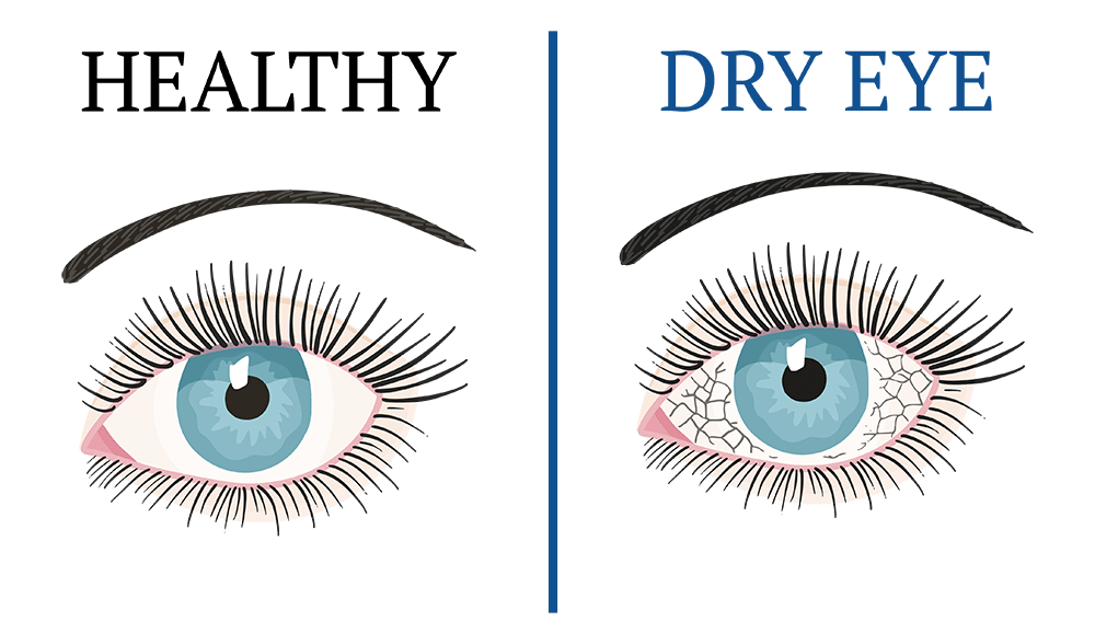 dry-eyes
