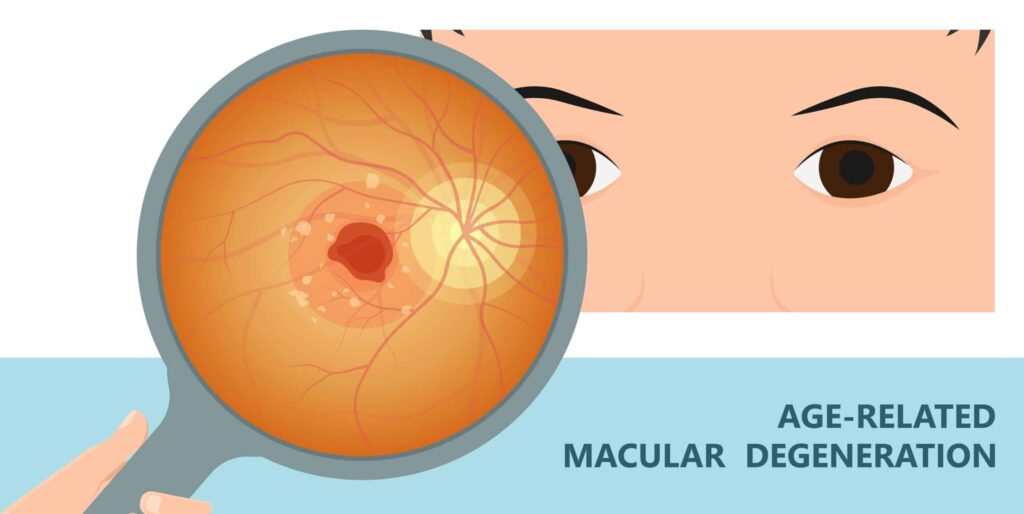 Aspirin and Age Related Macular Degeneration - Cohen Laser & Vision Center