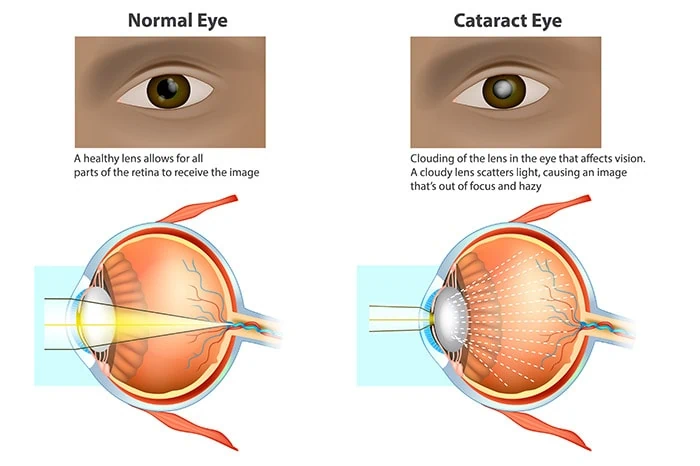 normal-eye-vs-cataract
